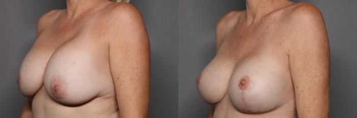 Before Breast Implant Exchange with Lift, Left Oblique View
