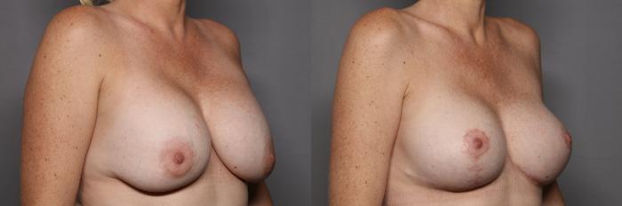 Before Breast Implant Exchange with Lift, Right Oblique View