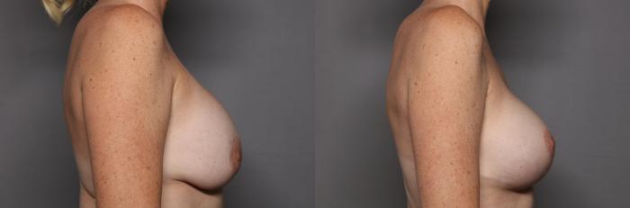 Before Breast Implant Exchange with Lift, Right SideView