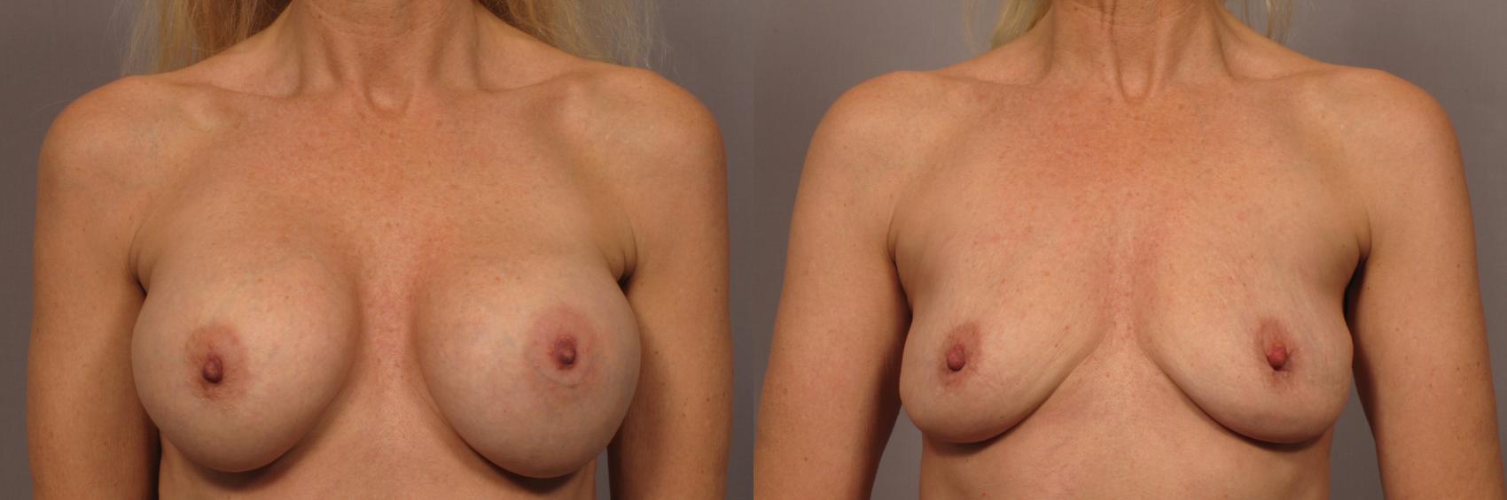 Before & After Breast Implant Removal Case 341 View #1 View in Naples and Ft. Myers, FL