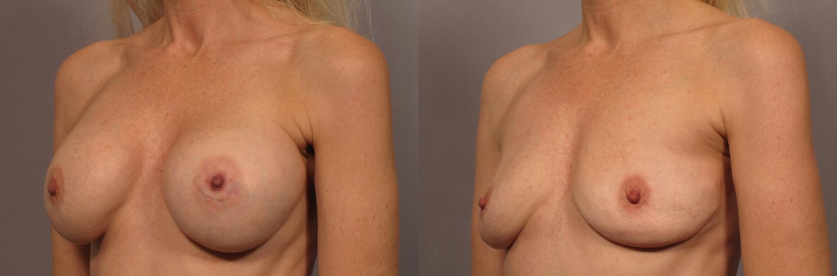 Before & After Breast Implant Removal Case 341 View #3 View in Naples and Ft. Myers, FL