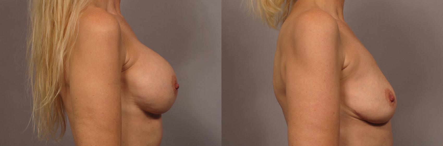 Before & After Breast Implant Removal Case 341 View #4 View in Naples and Ft. Myers, FL