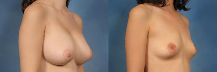 Before & After Breast Implant Removal Case 342 View #2 View in Naples and Ft. Myers, FL