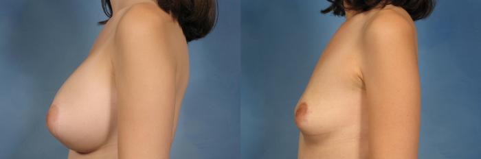 Before & After Breast Implant Removal Case 342 View #3 View in Naples and Ft. Myers, FL