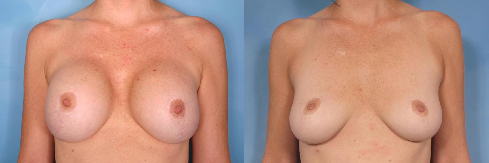 Before & After Breast Implant Removal Case 343 View #1 View in Naples and Ft. Myers, FL
