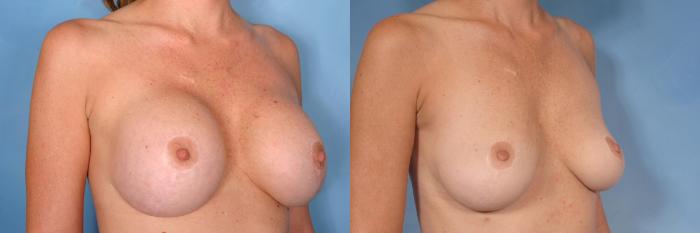 Before & After Breast Implant Removal Case 343 View #2 View in Naples and Ft. Myers, FL