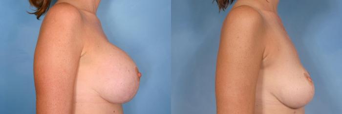 Before & After Breast Implant Removal Case 343 View #3 View in Naples and Ft. Myers, FL