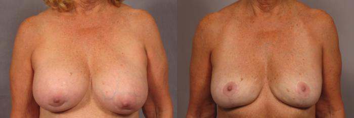 Before & After Breast Implant Removal Case 357 View #1 View in Naples and Ft. Myers, FL