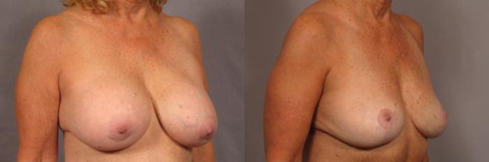 Before & After Breast Implant Removal Case 357 View #3 View in Naples and Ft. Myers, FL