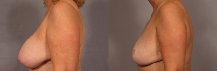 Before & After Breast Implant Removal Case 357 View #4 View in Naples and Ft. Myers, FL