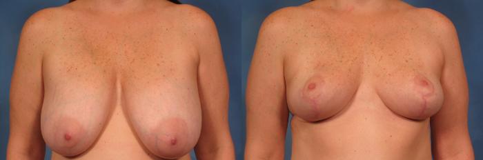 Before & After Breast Implant Removal Case 358 View #1 View in Naples and Ft. Myers, FL