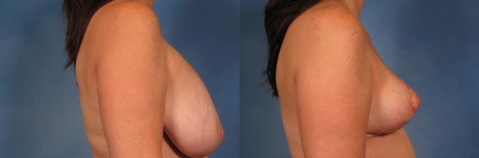 Before & After Breast Implant Removal Case 358 View #2 View in Naples and Ft. Myers, FL