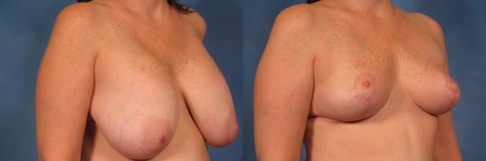 Before & After Breast Implant Removal Case 358 View #3 View in Naples and Ft. Myers, FL