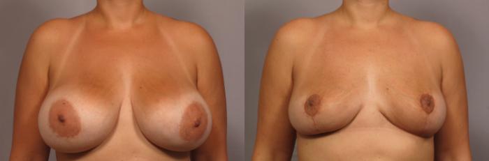 Before & After Breast Implant Removal Case 359 View #1 View in Naples and Ft. Myers, FL