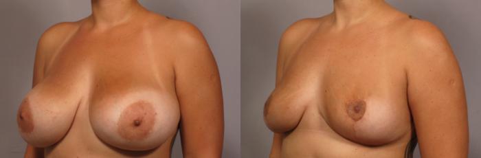 Before & After Breast Implant Removal Case 359 View #2 View in Naples and Ft. Myers, FL