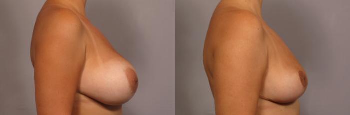 Before & After Breast Implant Removal Case 359 View #3 View in Naples and Ft. Myers, FL
