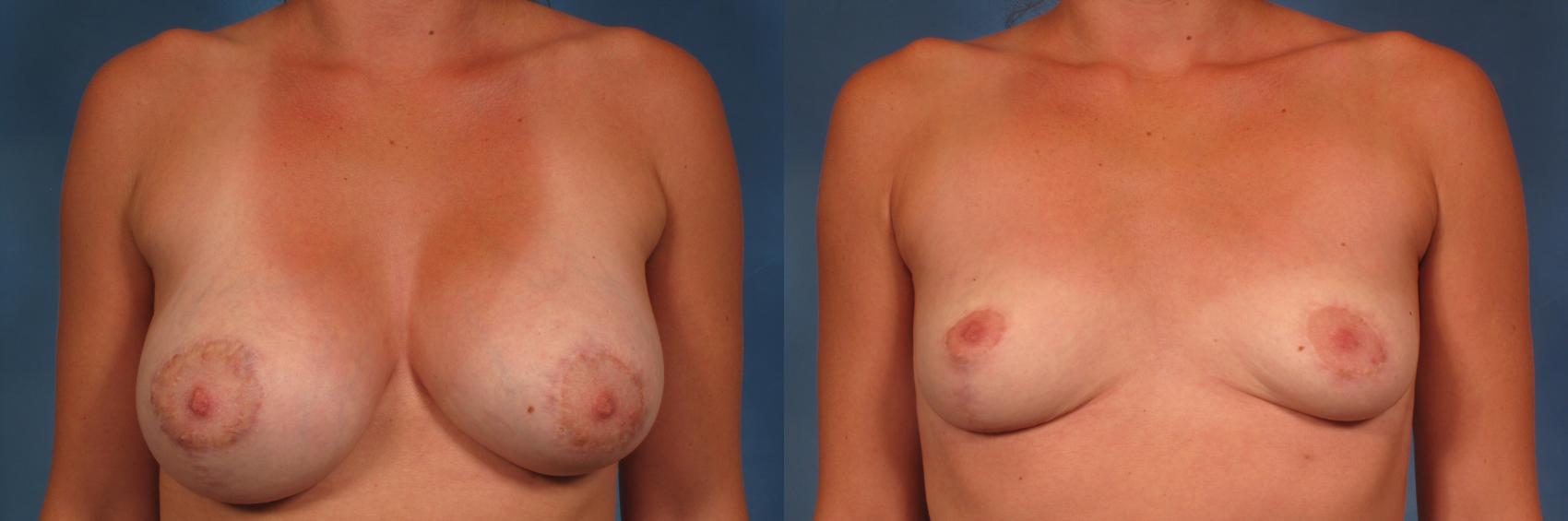 Before & After Breast Implant Removal Case 360 View #1 View in Naples and Ft. Myers, FL
