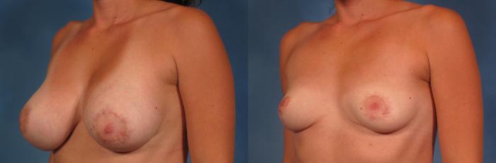 Before & After Breast Implant Removal Case 360 View #2 View in Naples and Ft. Myers, FL
