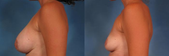 Before & After Breast Implant Removal Case 360 View #3 View in Naples and Ft. Myers, FL