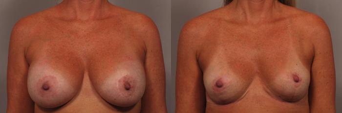 Before & After Breast Implant Removal Case 361 View #1 View in Naples and Ft. Myers, FL