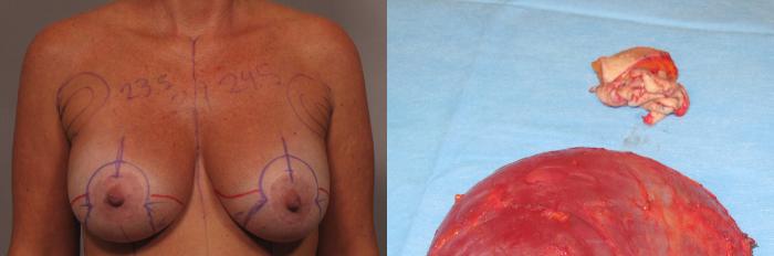 Before & After Breast Implant Removal Case 361 View #2 View in Naples and Ft. Myers, FL