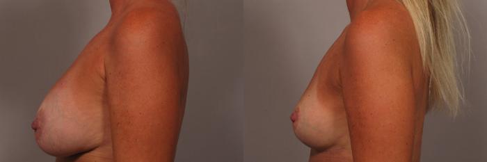 Before & After Breast Implant Removal Case 361 View #4 View in Naples and Ft. Myers, FL
