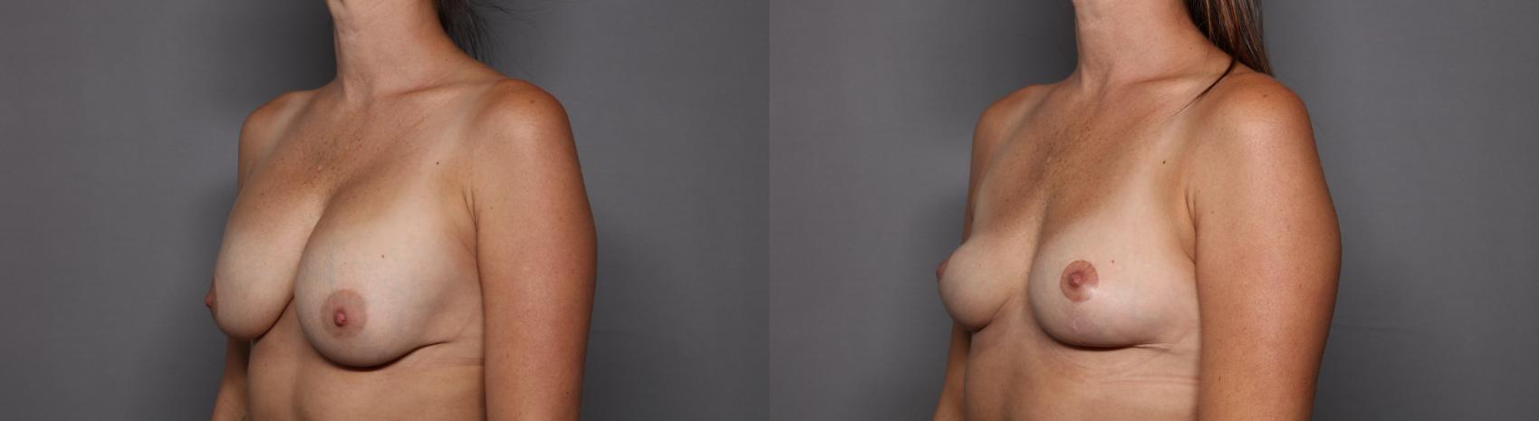 Breast Implant Removal and Breast Lift Left Oblique View Before