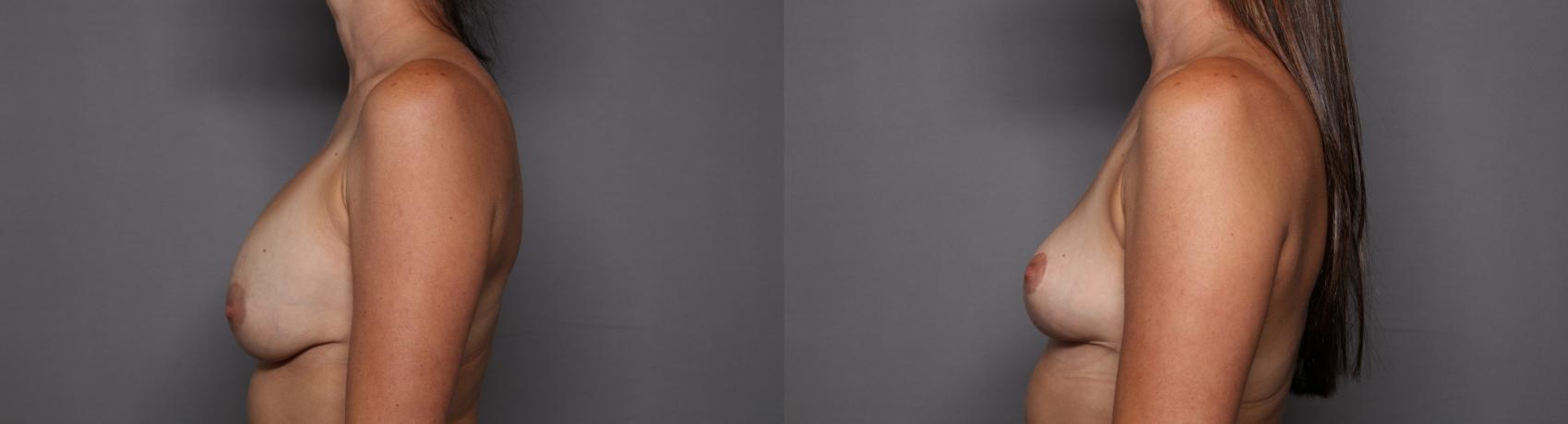 Breast Implant Removal and Breast Lift Left Side View Before