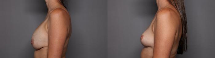 Breast Implant Removal and Breast Lift Left Side View Before