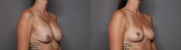 Breast Implant Removal and Breast Right Oblique  View Before
