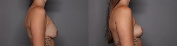 Breast Implant Removal and Breast Lift Right Side View Before