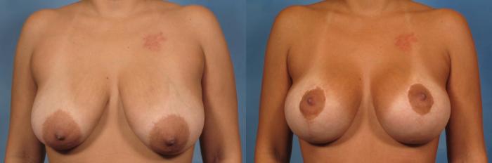 Before & After Breast Lift Case 138 View #1 View in Naples and Ft. Myers, FL
