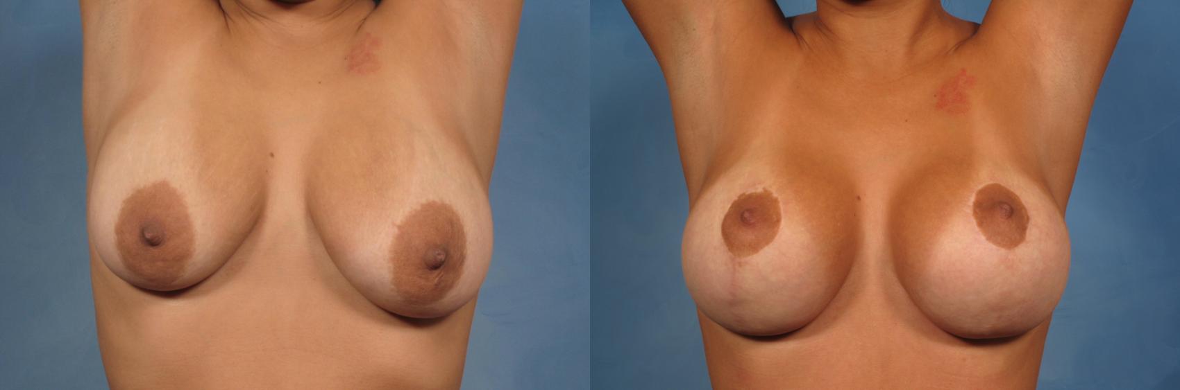 Before & After Breast Lift Case 138 View #2 View in Naples and Ft. Myers, FL