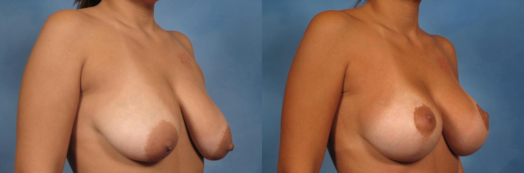 Before & After Breast Lift Case 138 View #3 View in Naples and Ft. Myers, FL