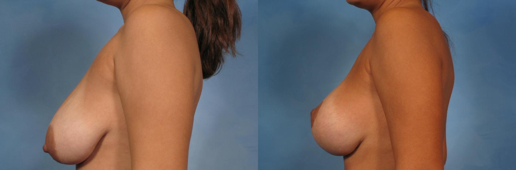 Before & After Breast Lift Case 138 View #4 View in Naples and Ft. Myers, FL