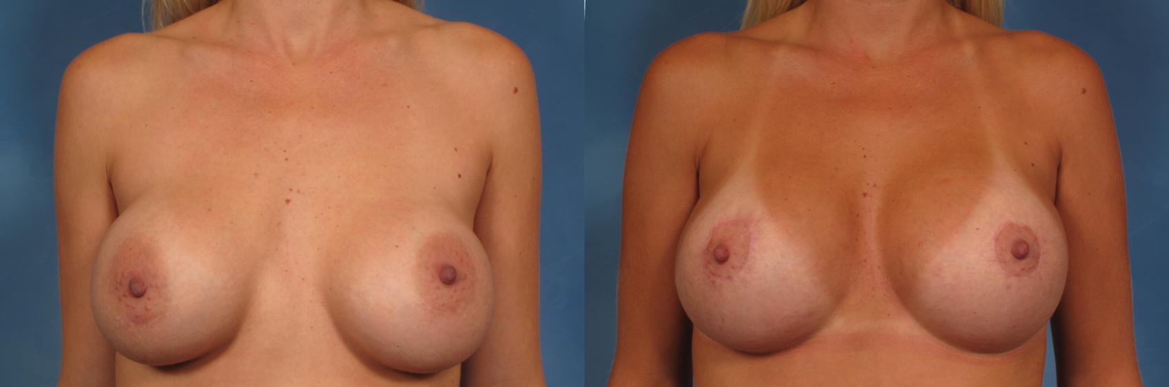 Before & After Breast Lift Case 148 View #1 View in Naples, FL