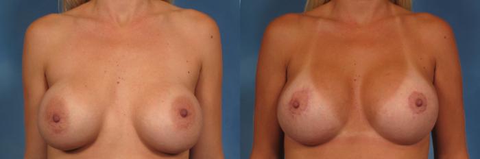 Before & After Breast Lift Case 148 View #1 View in Naples and Ft. Myers, FL
