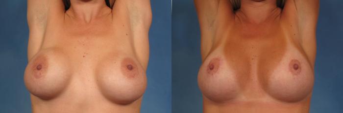 Before & After Breast Lift Case 148 View #2 View in Naples and Ft. Myers, FL
