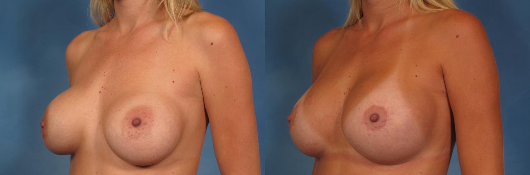 Before & After Breast Lift Case 148 View #3 View in Naples and Ft. Myers, FL