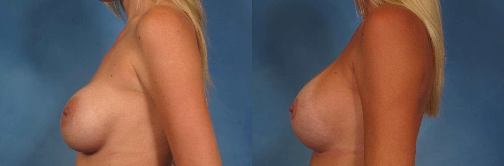 Before & After Breast Lift Case 148 View #4 View in Naples and Ft. Myers, FL