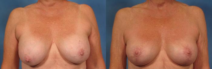 Before & After Breast Lift Case 169 View #1 View in Naples and Ft. Myers, FL