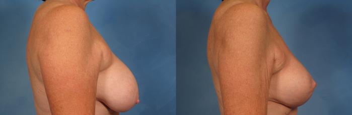 Before & After Breast Lift Case 169 View #2 View in Naples and Ft. Myers, FL