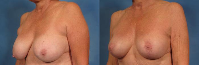 Before & After Breast Lift Case 169 View #3 View in Naples and Ft. Myers, FL