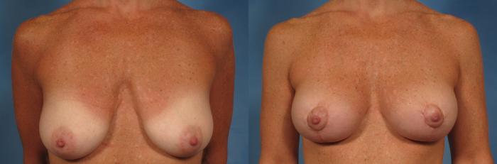 Before & After Breast Lift Case 199 View #1 View in Naples and Ft. Myers, FL
