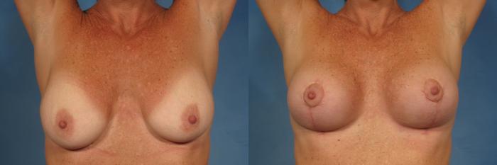 Before & After Breast Lift Case 199 View #2 View in Naples and Ft. Myers, FL