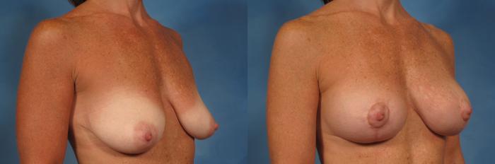 Before & After Breast Lift Case 199 View #3 View in Naples and Ft. Myers, FL