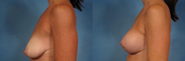 Before & After Breast Lift Case 199 View #4 View in Naples and Ft. Myers, FL