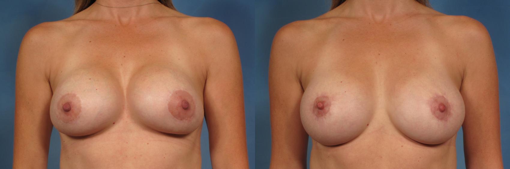 Before & After Breast Lift Case 200 View #1 View in Naples and Ft. Myers, FL