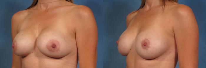 Before & After Breast Lift Case 200 View #2 View in Naples and Ft. Myers, FL