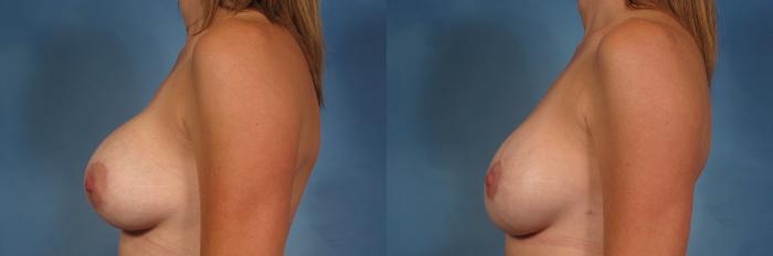 Before & After Breast Lift Case 200 View #3 View in Naples and Ft. Myers, FL